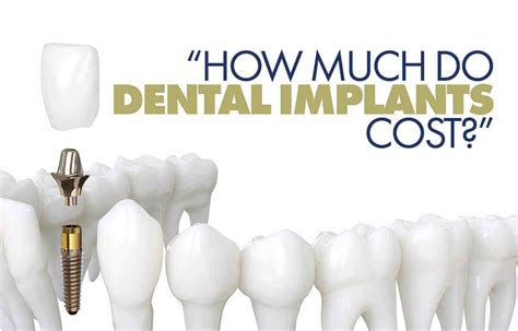 What Is The Cost For Dental Implants Dental News Network