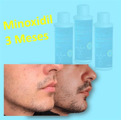 Minoxidil Meses Minoxidil Df Ventas