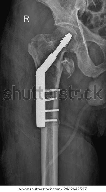 Fixation Framework Stock Photos - 48 Images | Shutterstock