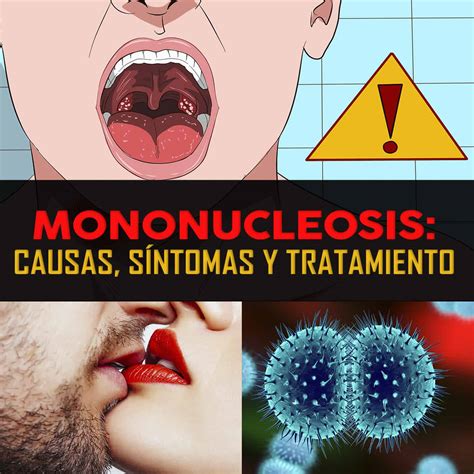 Mononucleosis causas síntomas y tratamiento La Guía de las Vitaminas