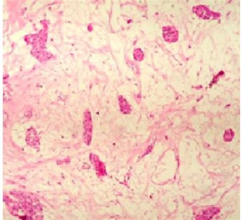 Histology Of The Tumor Showing The Ductal Epithelial And Myoepithelial