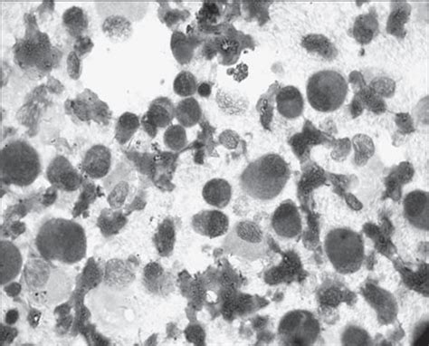 Fnac Smear Showing A Dissociated Population Of Medium To Large Download Scientific Diagram