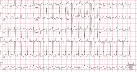 Hyperkalemia Ecg Stampede