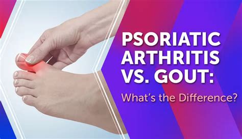 Psoriatic Arthritis vs. Gout: What’s the Difference? | MyPsoriasisTeam