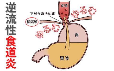 逆流性食道炎を引き起こす3つ原因を解説｜堺市いたわり健康院 さかい快福整体堂 Newscast