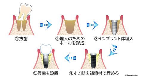 抜歯即時埋入インプラント 【港区】浜松町でインプラントができる歯医者なら大西歯科