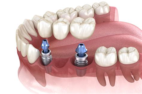 Dental Implants In Louisville Ky Harmon Dental Center