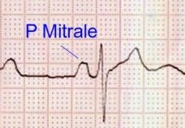 P Mitrale – Left atrial abnormality / overload – All About Cardiovascular System and Disorders