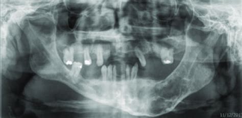 Preoperative Orthopantogram Showing Multilocular Radiolucency Of The