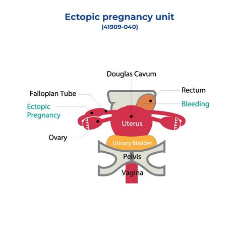 Ectopic Pregnancy Unit