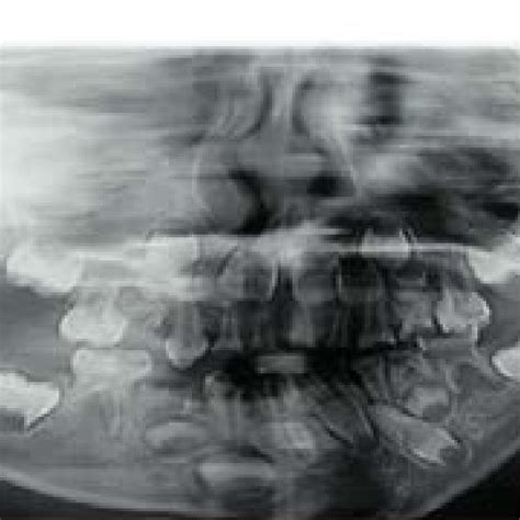 Panoramic radiograph of the patient showing severe mandibular ...