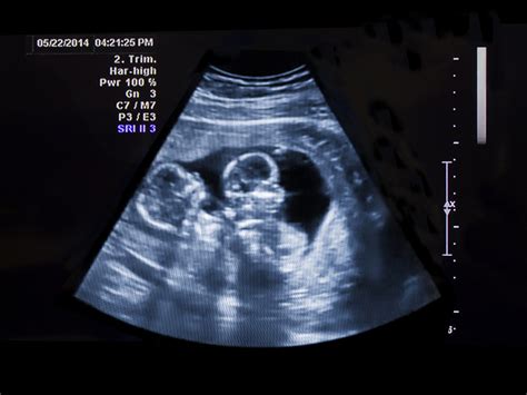 ultrasound  check  position   placenta babycenter