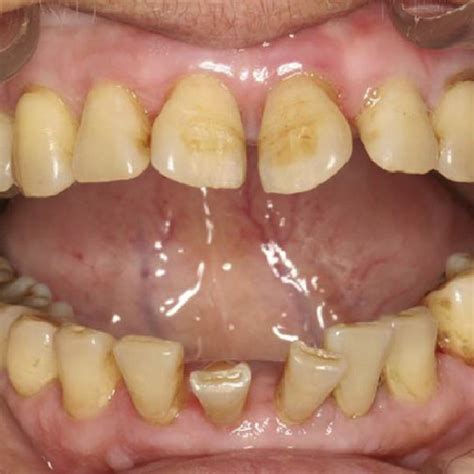 Pdf Phenytoin And Amlodipine Induced Gingival Overgrowth