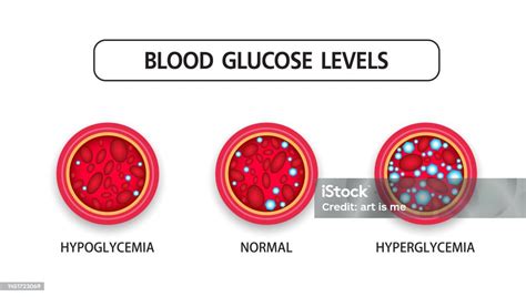 Hyperglycemia High Blood Sugar And Diabetes Obesity Is A Serious