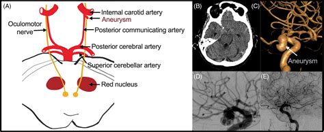 Third Nerve Palsy Due to Intracranial Aneurysms and Recovery after Endovascular Coiling ...