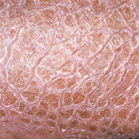 Ichthyosis Zeroderma