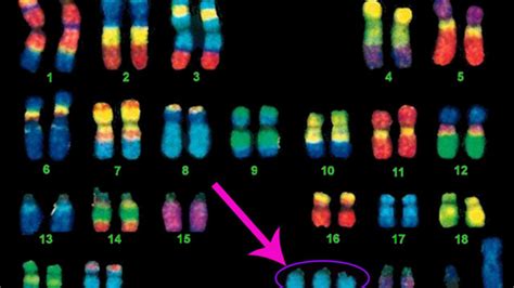 Down Syndrome Chromosomes