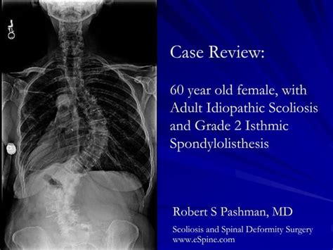 Case Review 31 60 Year Old Female With Adult Idiopathic Scoliosis Ppt