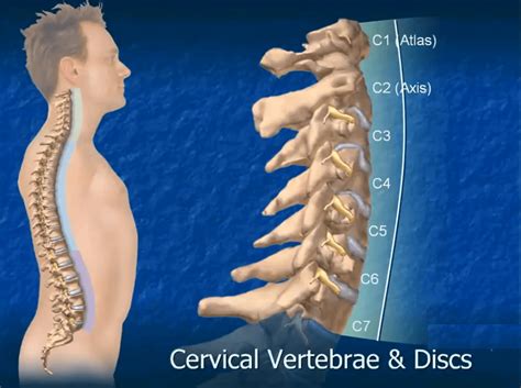 Degenerative Disc In The Neck