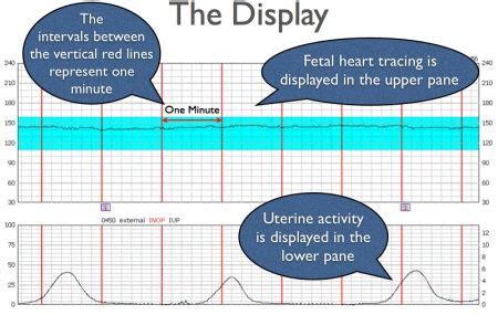 A Guide To Electronic Fetal Monitoring Cardiotocogram Stepwards