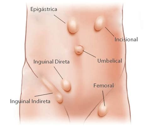 H Rnia Da Parede Abdominal Dr Claudio De Luca