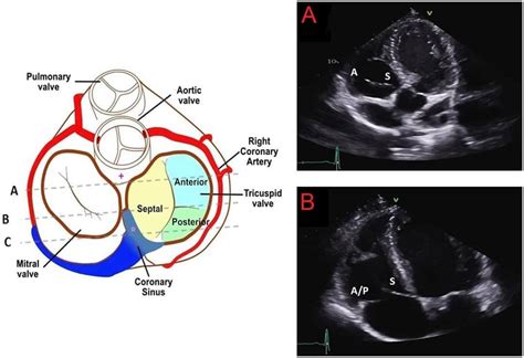 Echocardiographic Assessment Of The Tricuspid And Pulmonary Valves A