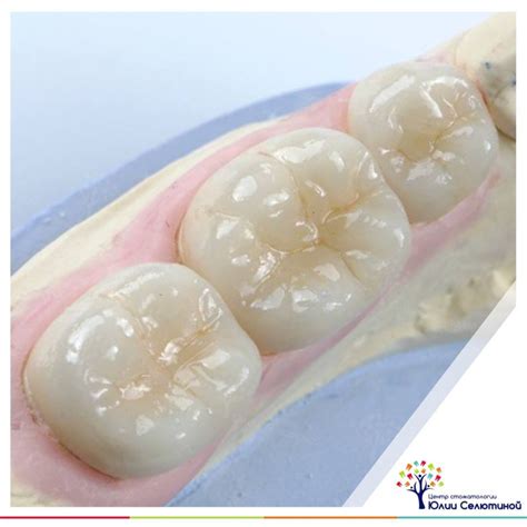 Все о коронках на зубы | Юлия Селютина | Дзен
