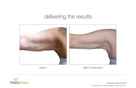 Venus Versa Treatments Advanced Aesthetics Of North Texas