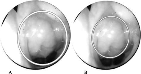 SciELO Brasil Reliability Of Nasofibroscopy For The Evaluation Of