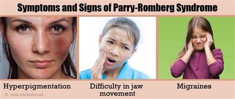 Symptoms and Signs of Parry-Romberg Syndrome