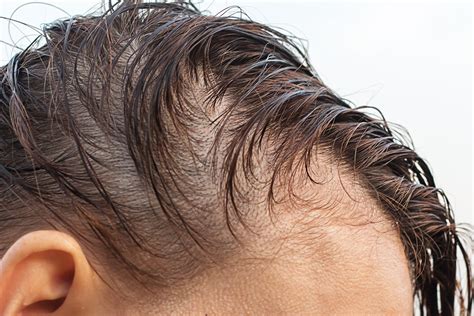 Thinning Hair Treatments Skin Md Laser And Cosmetic Group