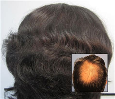 Hair Transplant Los Angeles - Dr Sean Behnam MD