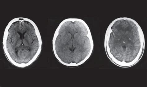 Edema Otak Patofisiologi Diagnosis Penatalaksanaan Alomedika