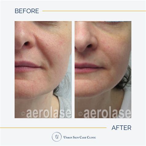 Aerolase Neo Elite Laser Treatment Urban Skin Care Clinic