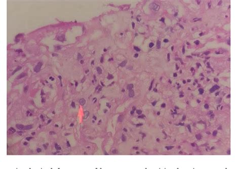 Figure 1 From Herpes Simplex Esophagitis In An Immunocompetent Host A