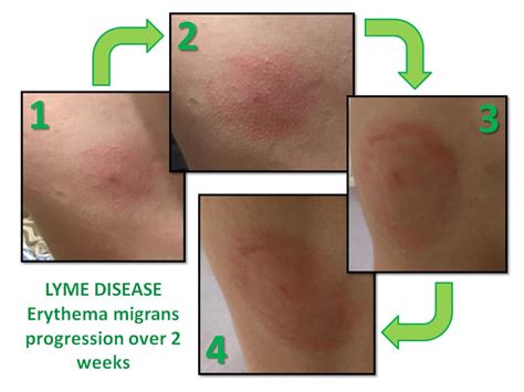 Lyme Disease Rash Identification Diagnosis And Treatment The Chupitos