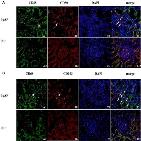 Frontiers The Role of Renal Macrophage AIM and TGF β1 Expression in