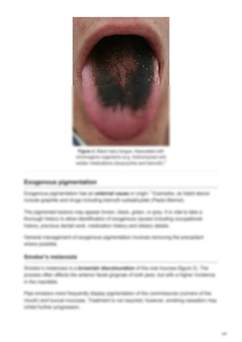 SOLUTION Pigmented Lesions Of The Oral Cavity Studypool