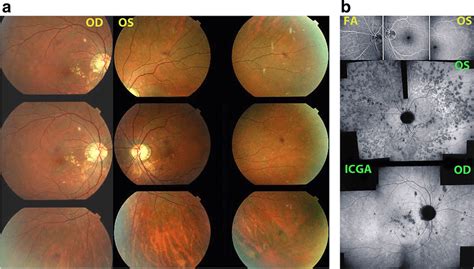 Multifocal Choroiditis Mfc Fundus Pictures Ods Typical Chorioretinal