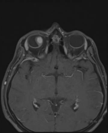 Choroidal melanoma | Radiology Case | Radiopaedia.org