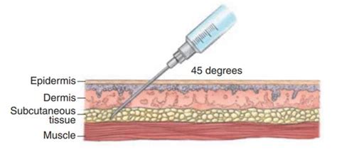 Subcutaneous Route Of Drug Administration Advantages And Disadvantages