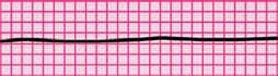 Asystole ~ Nursing