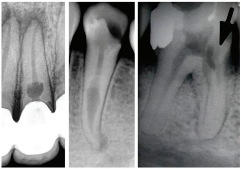 Internal Root Resorption A Unique Entity