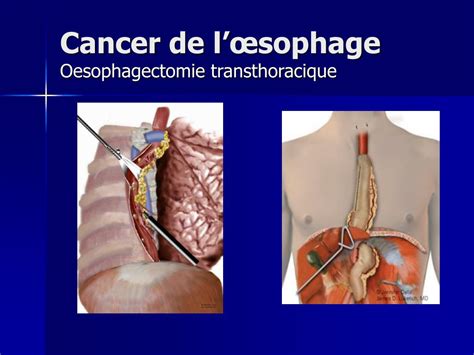 PPT Comment Je Fais Une Oesophagectomie PowerPoint Presentation ID