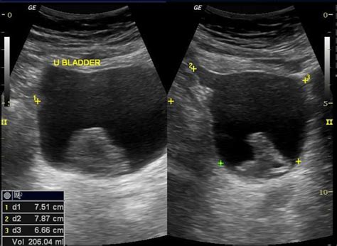 Transitional Cell Carcinoma