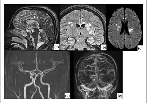 Fulminant Susac Syndromea Rare Cause Of Coma The History Of The Fatal