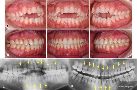 Risques Et Limitations D Un Traitement D Orthodontie B Cco