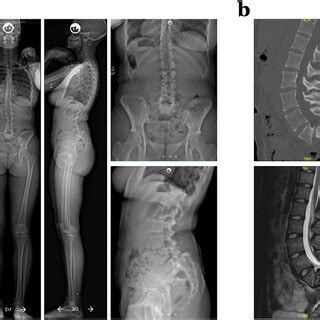 Plain Radiographs Anteroposterior Far Left And Top Right And Lateral