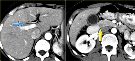 The Radiology Assistant Biliary Duct Pathology