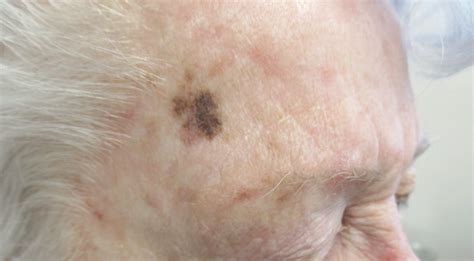 Can You Identify This Asymptomatic Lesion On An Elderly Mans Temple